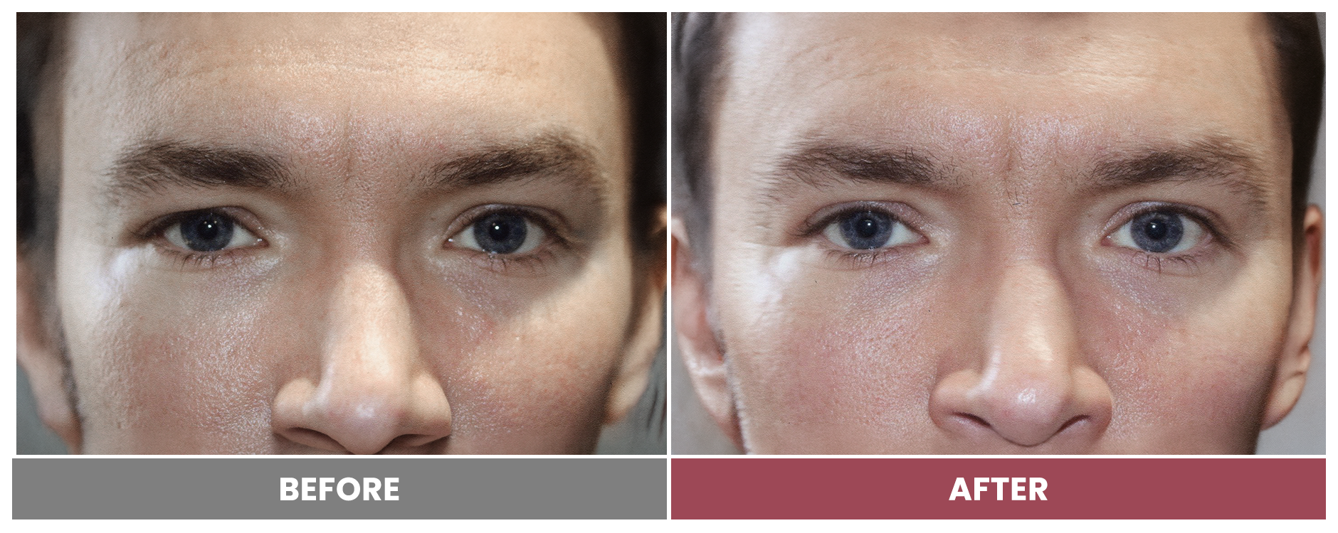 Upper Blepharoplasty - Case 58
